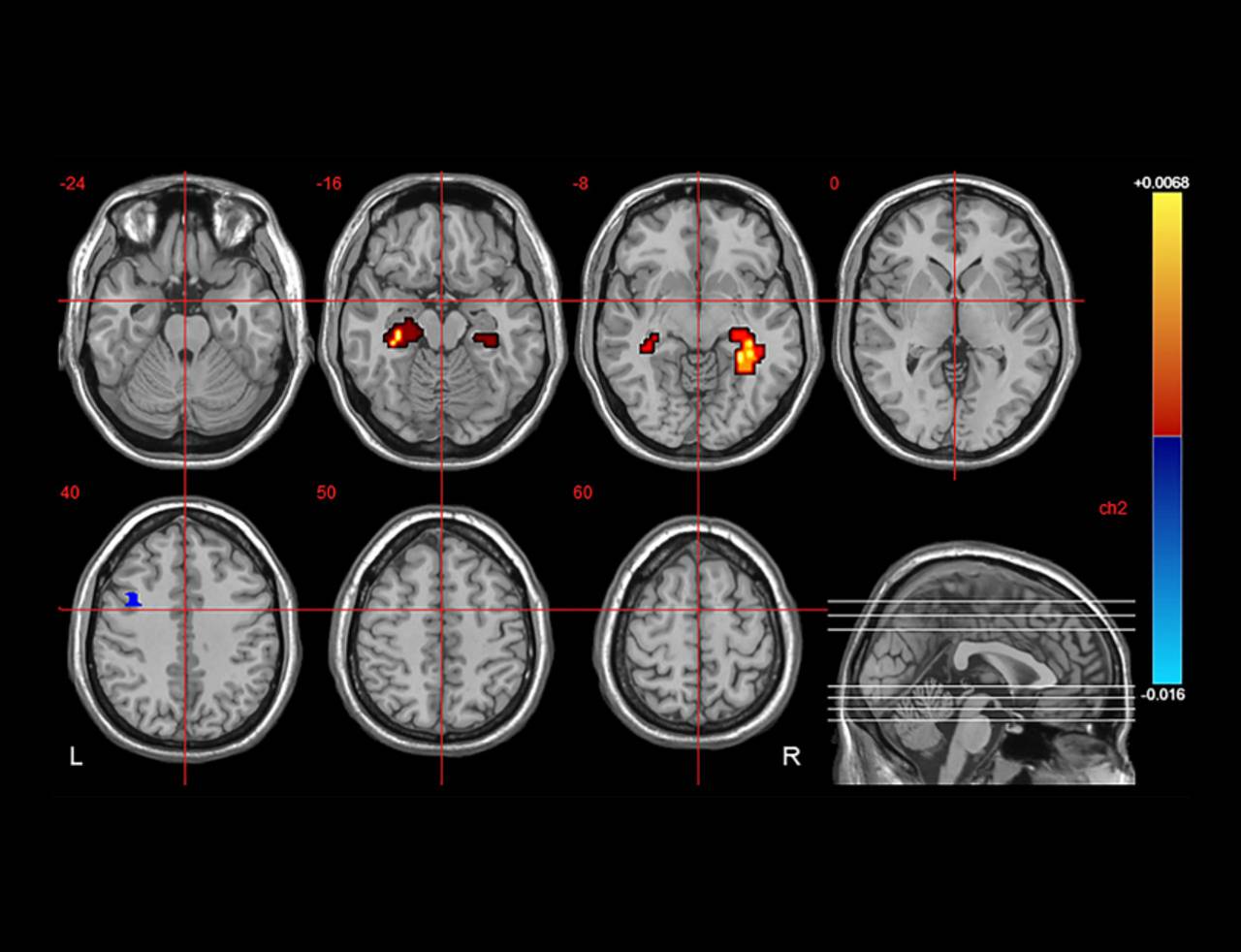 imagem dos cérebros e a medida que eles ficam com thc